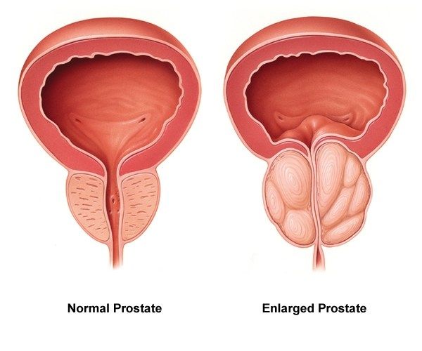 Prostate Problem Treatment