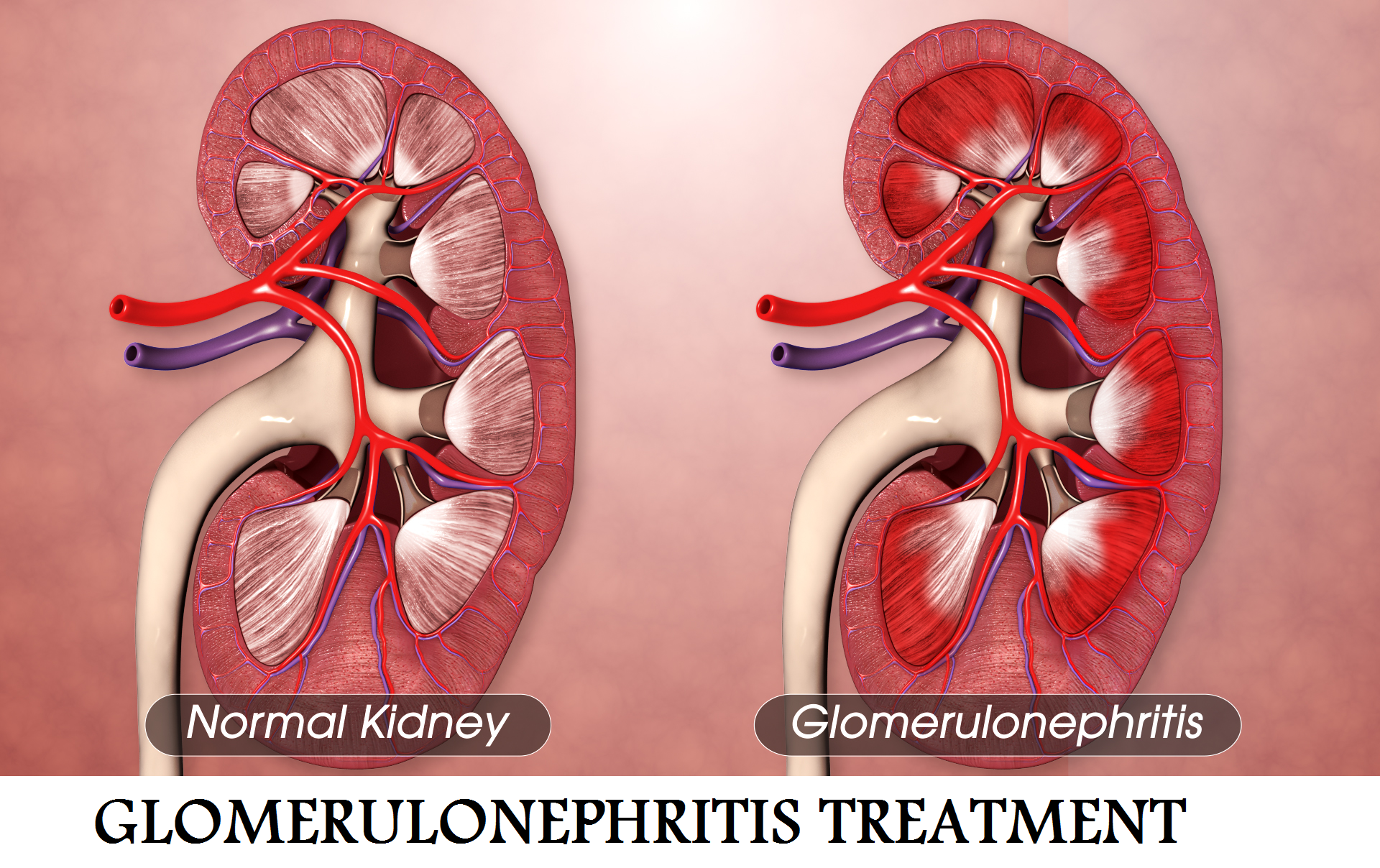 Glomerulonephritis Treatment