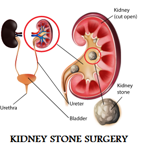 KIDNEY STONE SURGERY