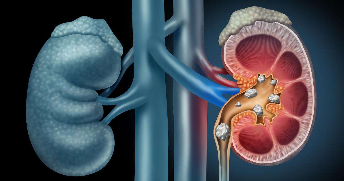 Doctor for Kidney Stone Surgery