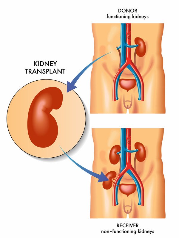 KIDNEY TRANSPLANT